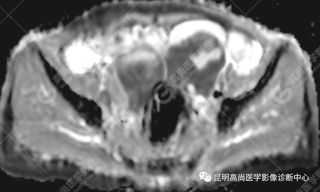 高尚病例:子宫癌肉瘤一例