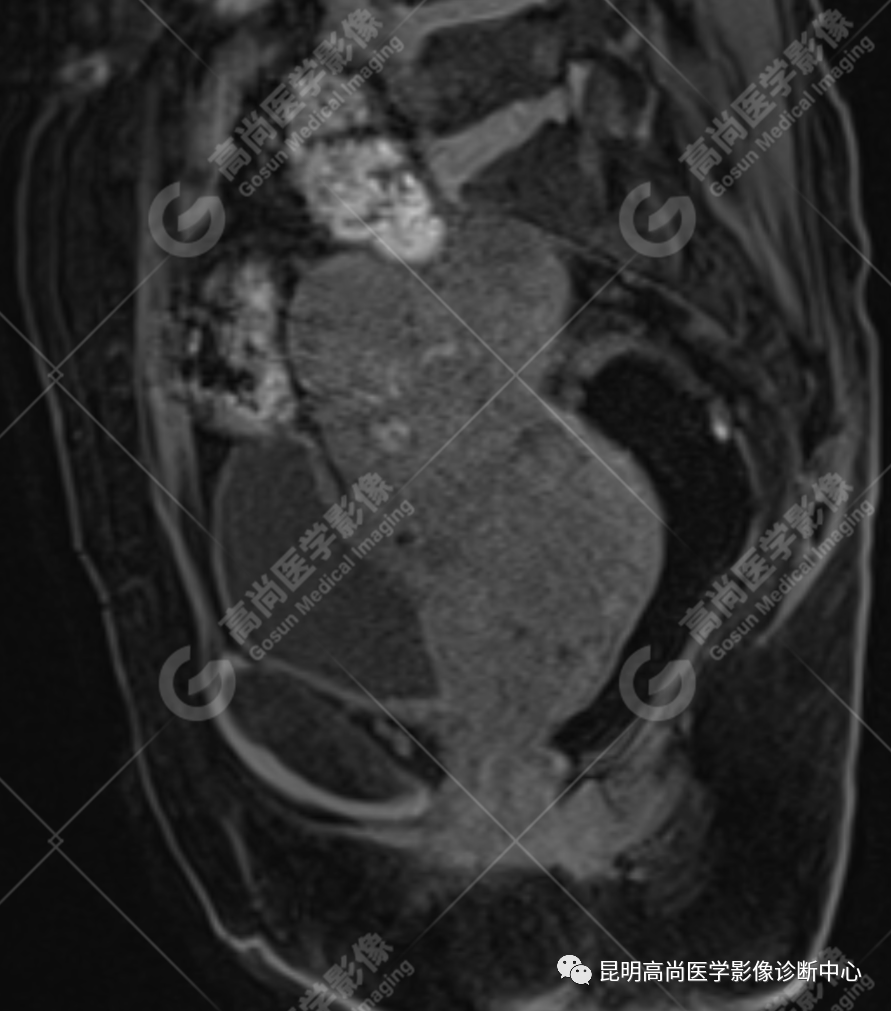 高尚病例:子宫癌肉瘤一例