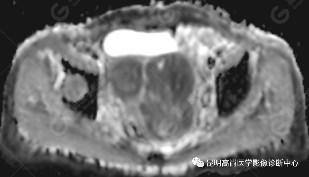 高尚病例:子宫癌肉瘤一例