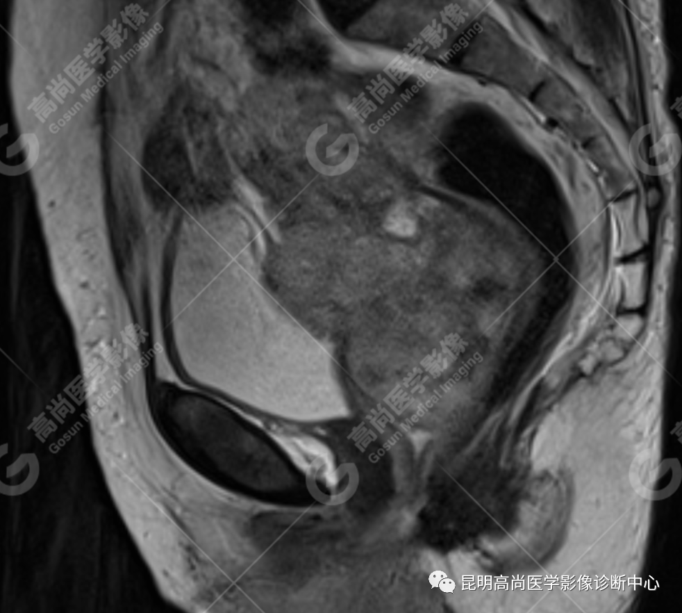 高尚病例:子宫癌肉瘤一例