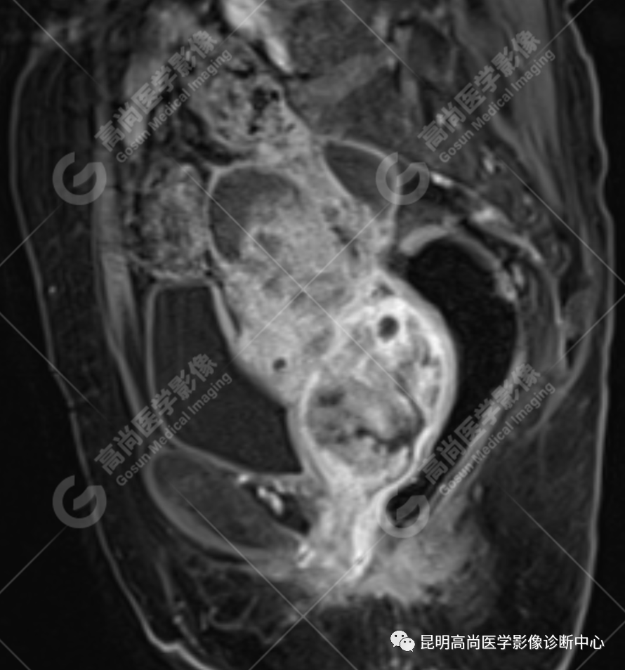 高尚病例:子宫癌肉瘤一例