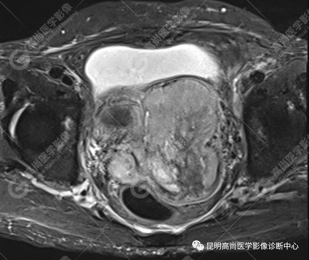 高尚病例:子宫癌肉瘤一例