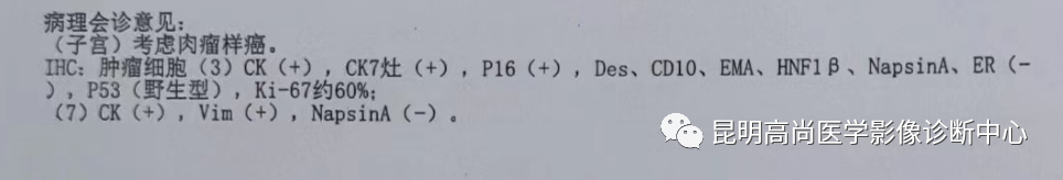 高尚病例:子宫癌肉瘤一例