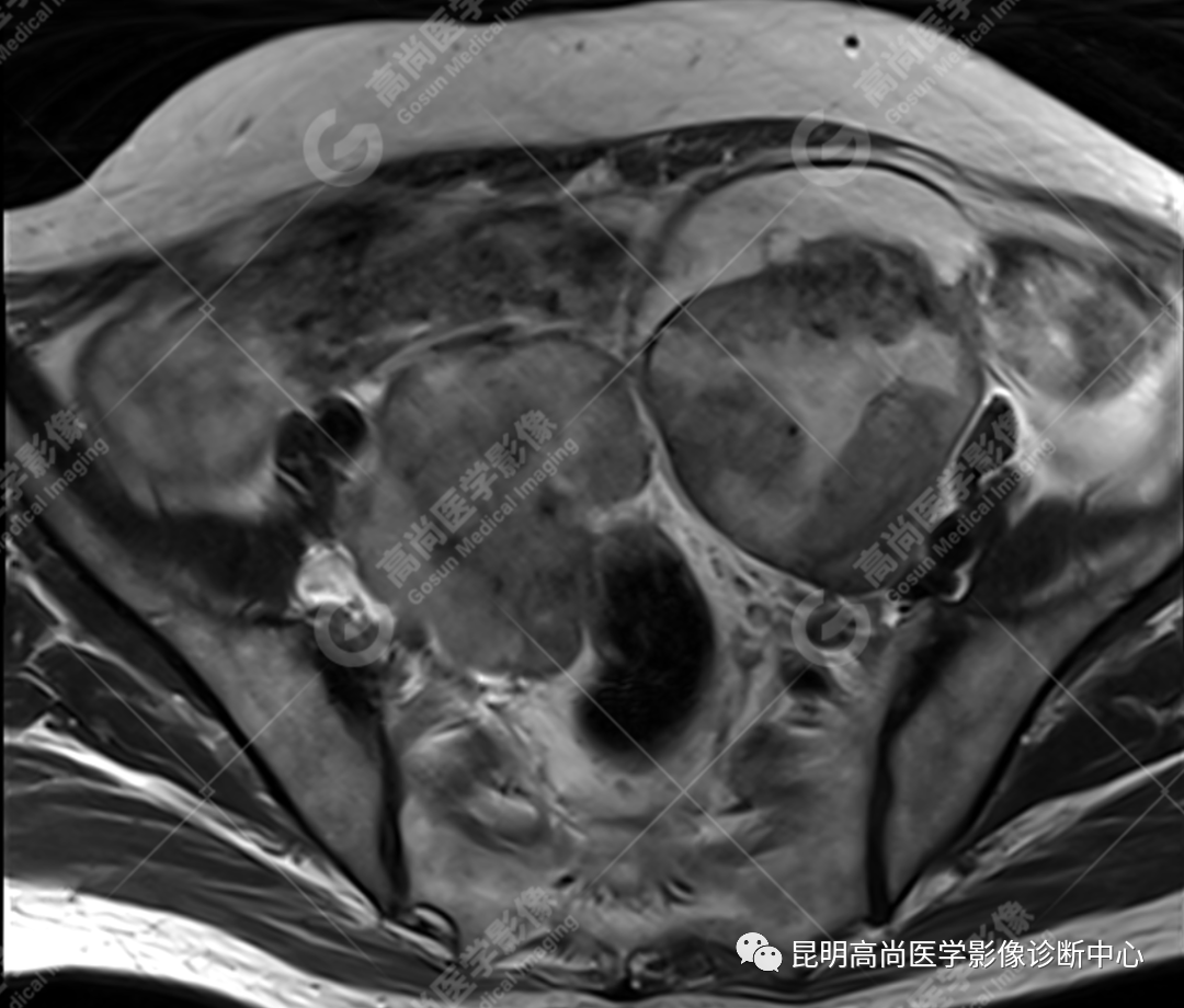 高尚病例:子宫癌肉瘤一例