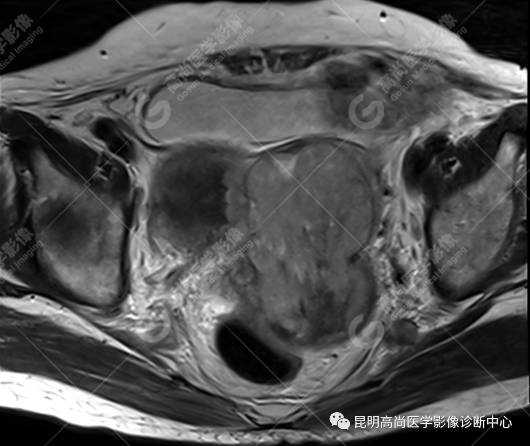 高尚病例:子宫癌肉瘤一例