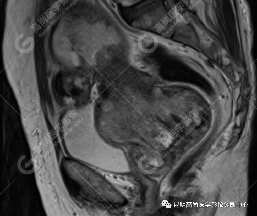 高尚病例:子宫癌肉瘤一例