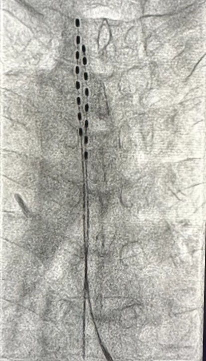 疼痛科：「生蛇」后痛到睡不着？脊髓电刺激疗法助他回归快乐生活
