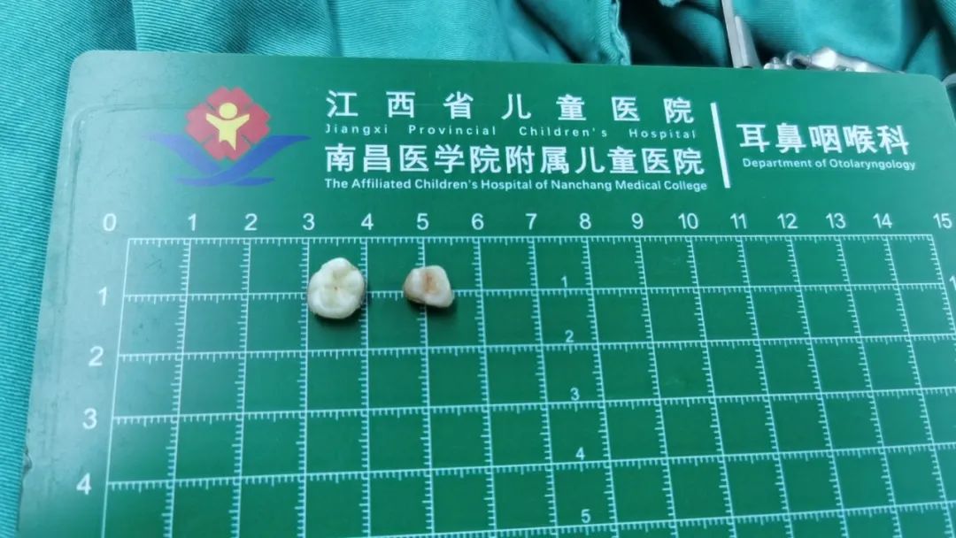 11 岁男童主气管里居然藏有牙齿，江西省儿童医院快速取出