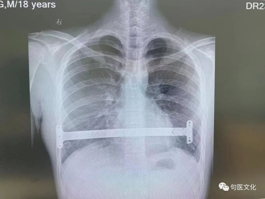 句容市人民医院胸外科成功开展一例胸腔镜下漏斗胸超微创矫形手术