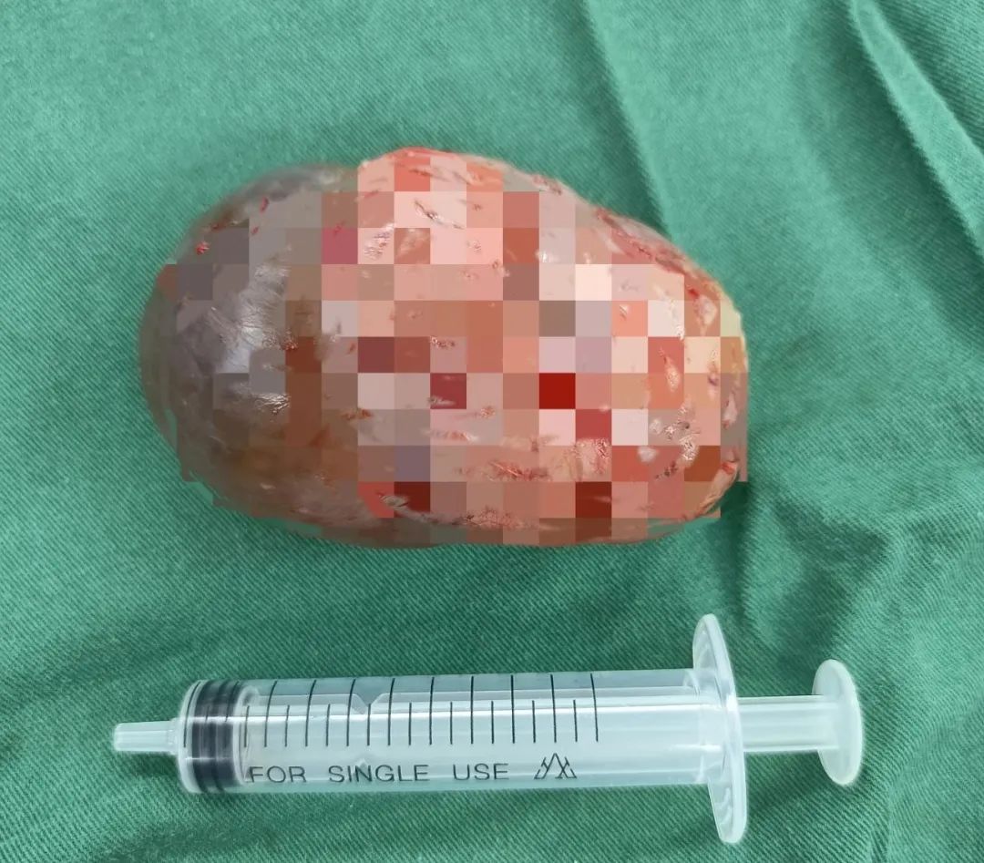 江西省儿童医院成功为八月大男宝实施睾丸肿瘤切除术