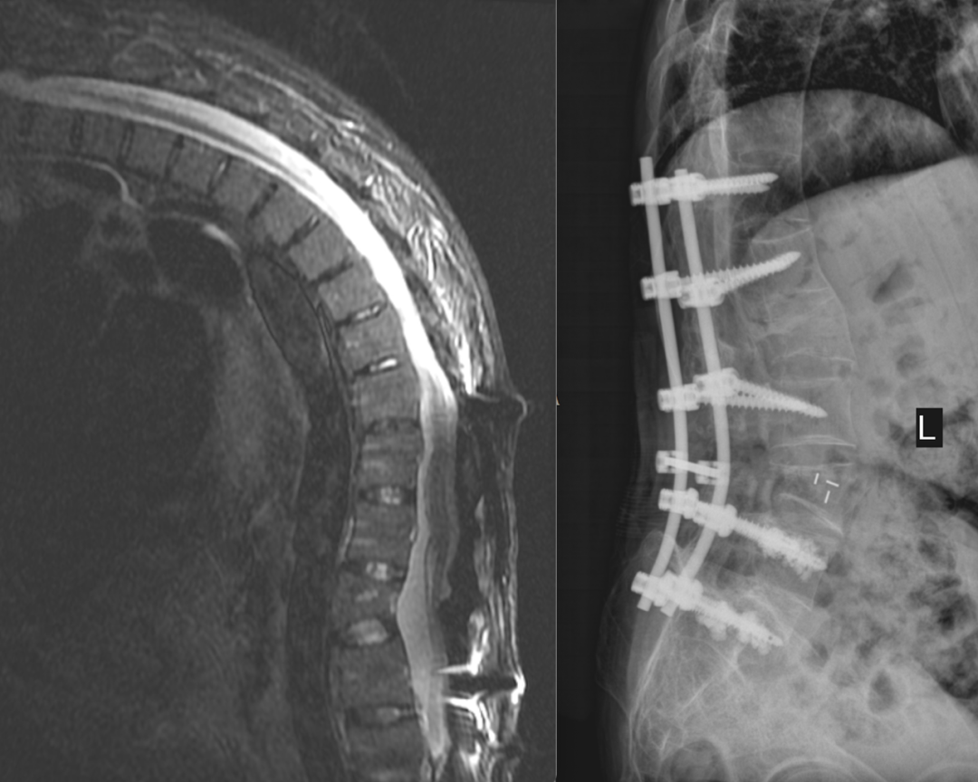 告别被「折叠」的 28 年,湄潭家礼医院为患者成功施行矫形手术