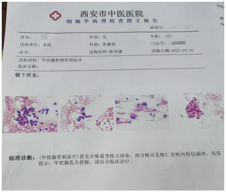 外科甲乳专业开展经锁骨下免充气腔镜下甲状腺癌根治术