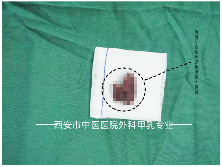 外科甲乳专业开展经锁骨下免充气腔镜下甲状腺癌根治术