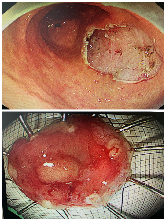 胃窦部肿瘤图片图片