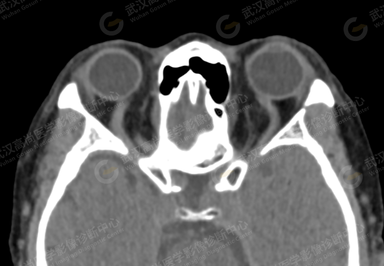 高尚病例：CTA 诊断硬脑膜动静脉瘘一例