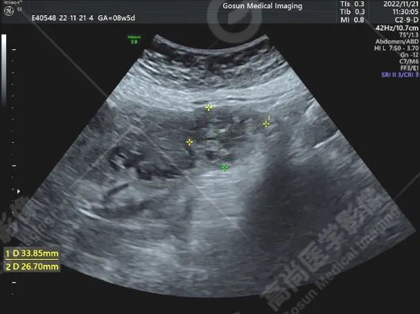 高尚超声：输卵管间质部妊娠