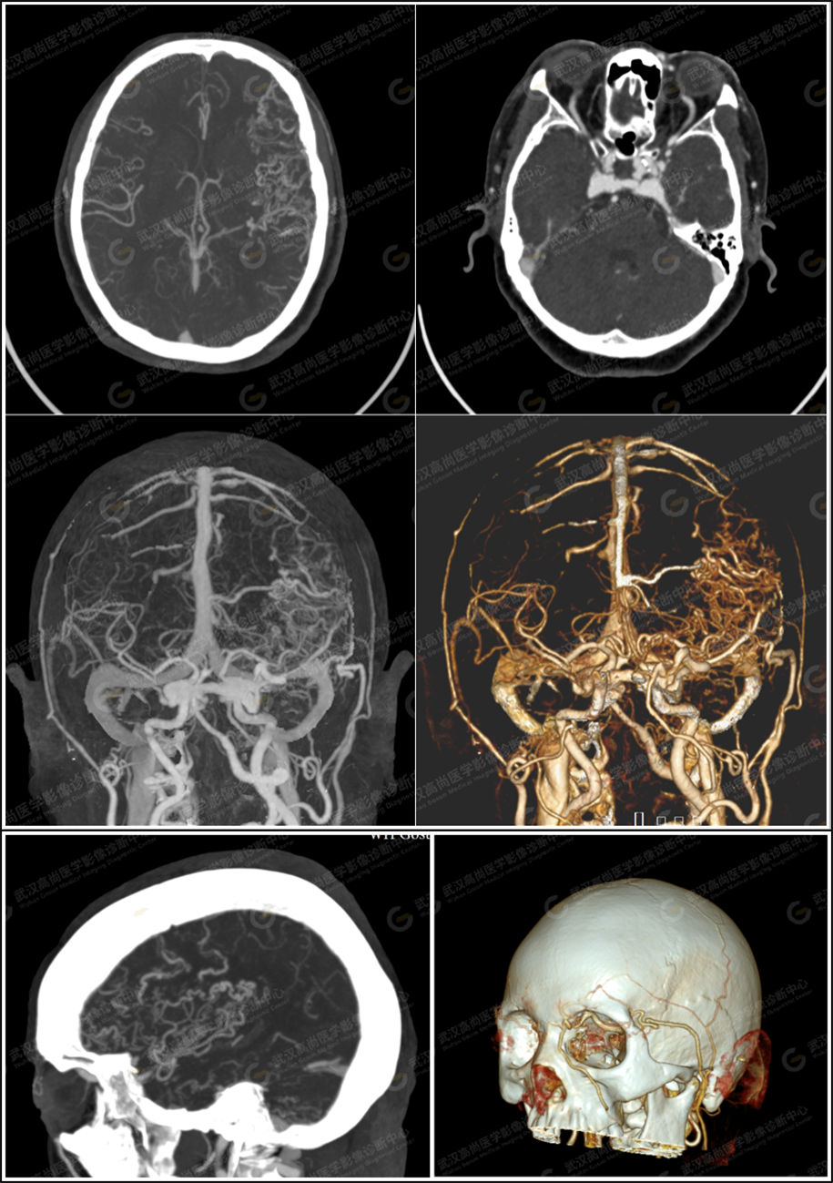 高尚病例：CTA 诊断硬脑膜动静脉瘘一例
