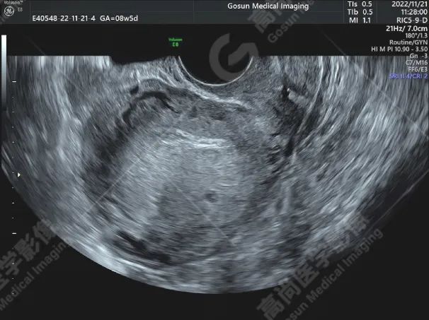 高尚超声：输卵管间质部妊娠