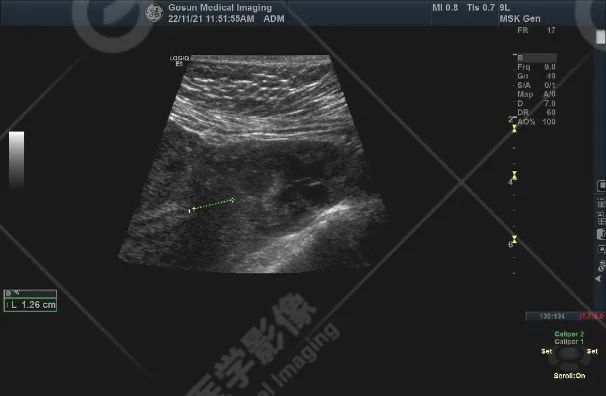 高尚超声：输卵管间质部妊娠