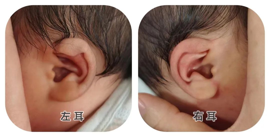 注意，耳廓畸形，居然超过一半的孩子都有! 越早医治越好