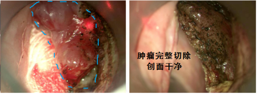 新技术！河南省肿瘤医院顺利完成二氧化碳激光喉癌切除术
