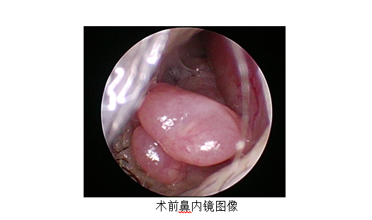 鼻子感染了 HPV 病毒？他拿到病理报告迟迟不敢相信......