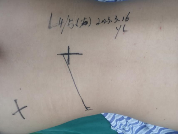 郑州中医骨伤病医院开展一例「行椎间孔镜微创手术」