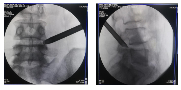 郑州中医骨伤病医院开展一例「行椎间孔镜微创手术」