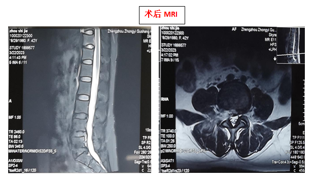 郑州中医骨伤病医院开展一例「行椎间孔镜微创手术」