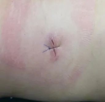 郑州中医骨伤病医院开展一例「行椎间孔镜微创手术」