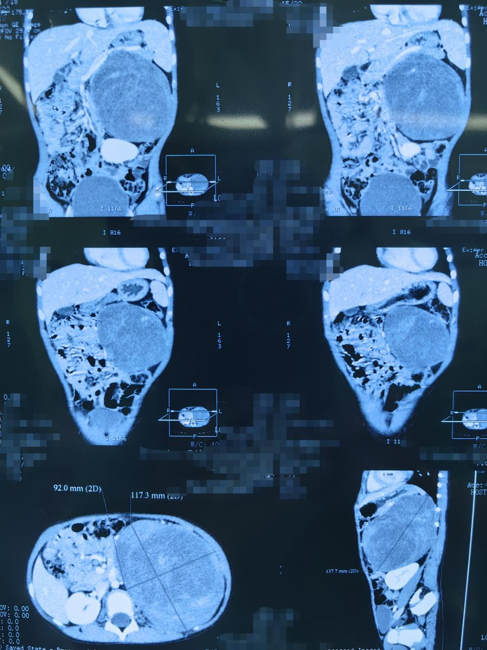 4 岁女童腹膜后巨大肿瘤，江西省儿童医院手术切除