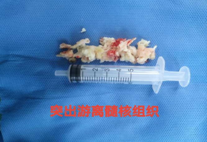 郑州中医骨伤病医院开展一例「行椎间孔镜微创手术」