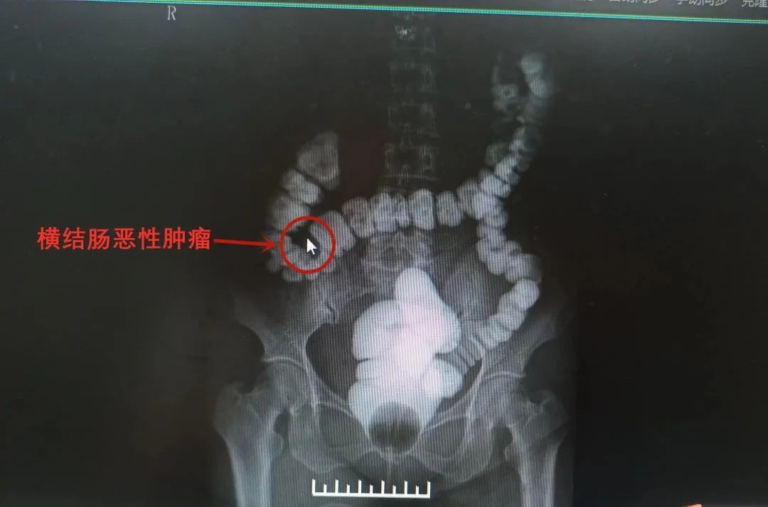 新技术铸就「肠寿刀」| 保留回盲部，告别全切！