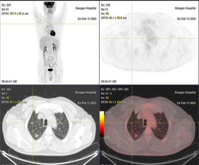 查出肺结节？别慌！PET-CT 帮你鉴别良恶性