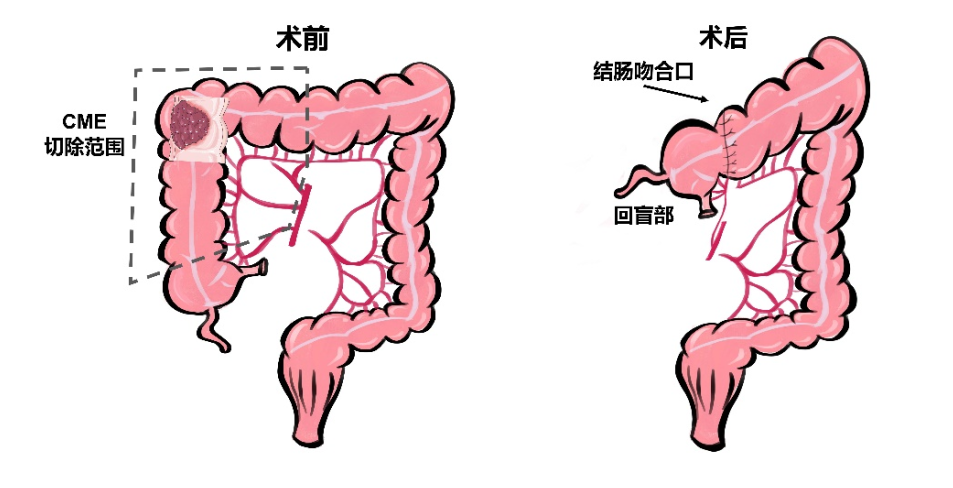 新技术铸就「肠寿刀」| 保留回盲部，告别全切！