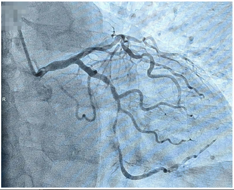 从手入心脑-西安市中医医院心血管病医院首例经桡动脉入路完成心脑联合造影及介入治疗