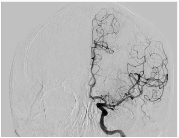 从手入心脑-西安市中医医院心血管病医院首例经桡动脉入路完成心脑联合造影及介入治疗