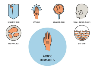 基于药物MOA诱导的过敏小鼠模型选择之特应性皮炎