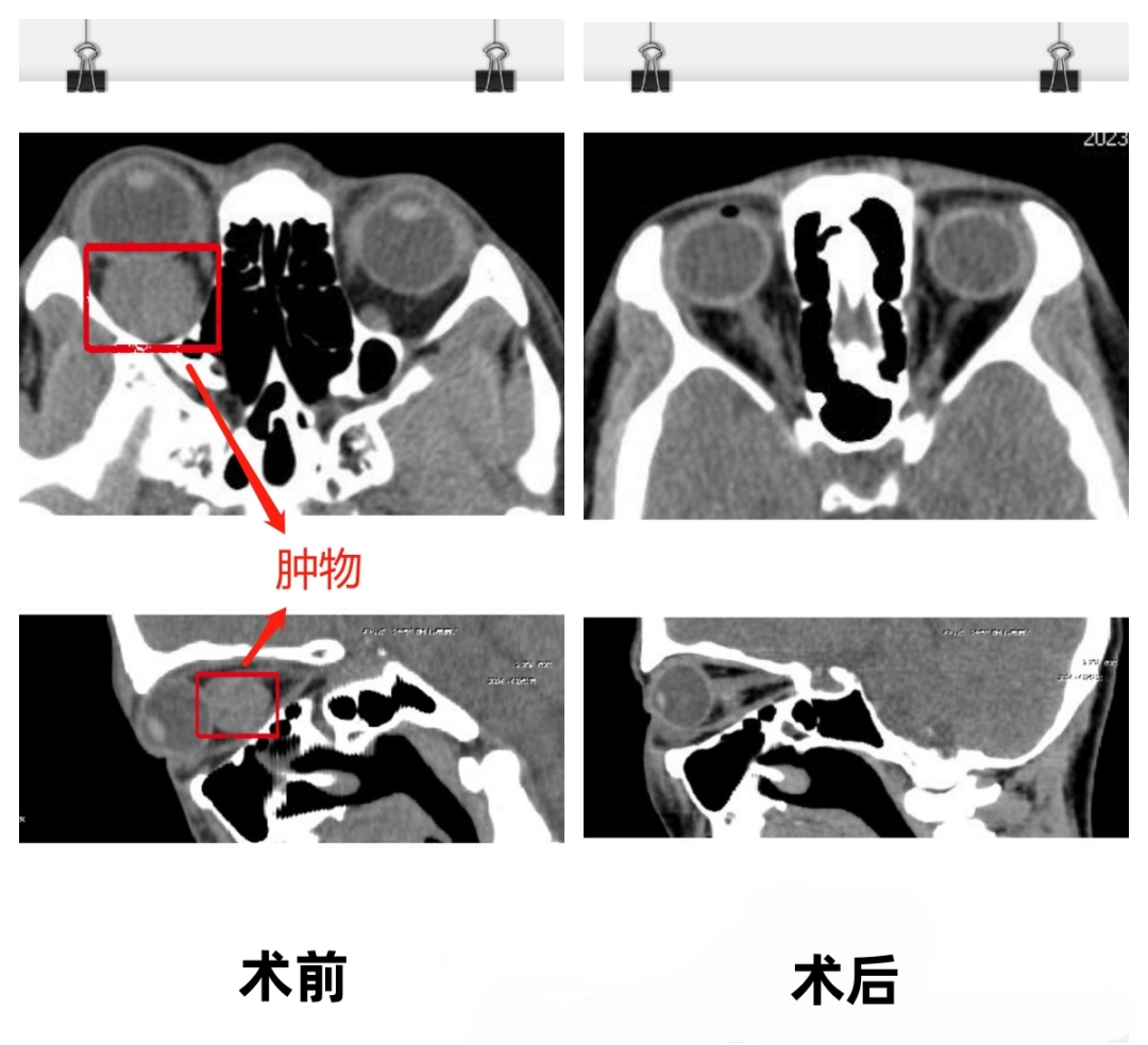 柳州市红十字会医院眼五病区成功开展眼眶球后巨大海绵状血管瘤摘除手术！
