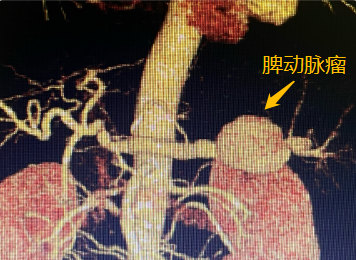 惊心动魄！动脉瘤破裂，医院响起 999，他们一个个化身短跑冠军冲进……