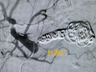 惊心动魄！动脉瘤破裂，医院响起 999，他们一个个化身短跑冠军冲进……