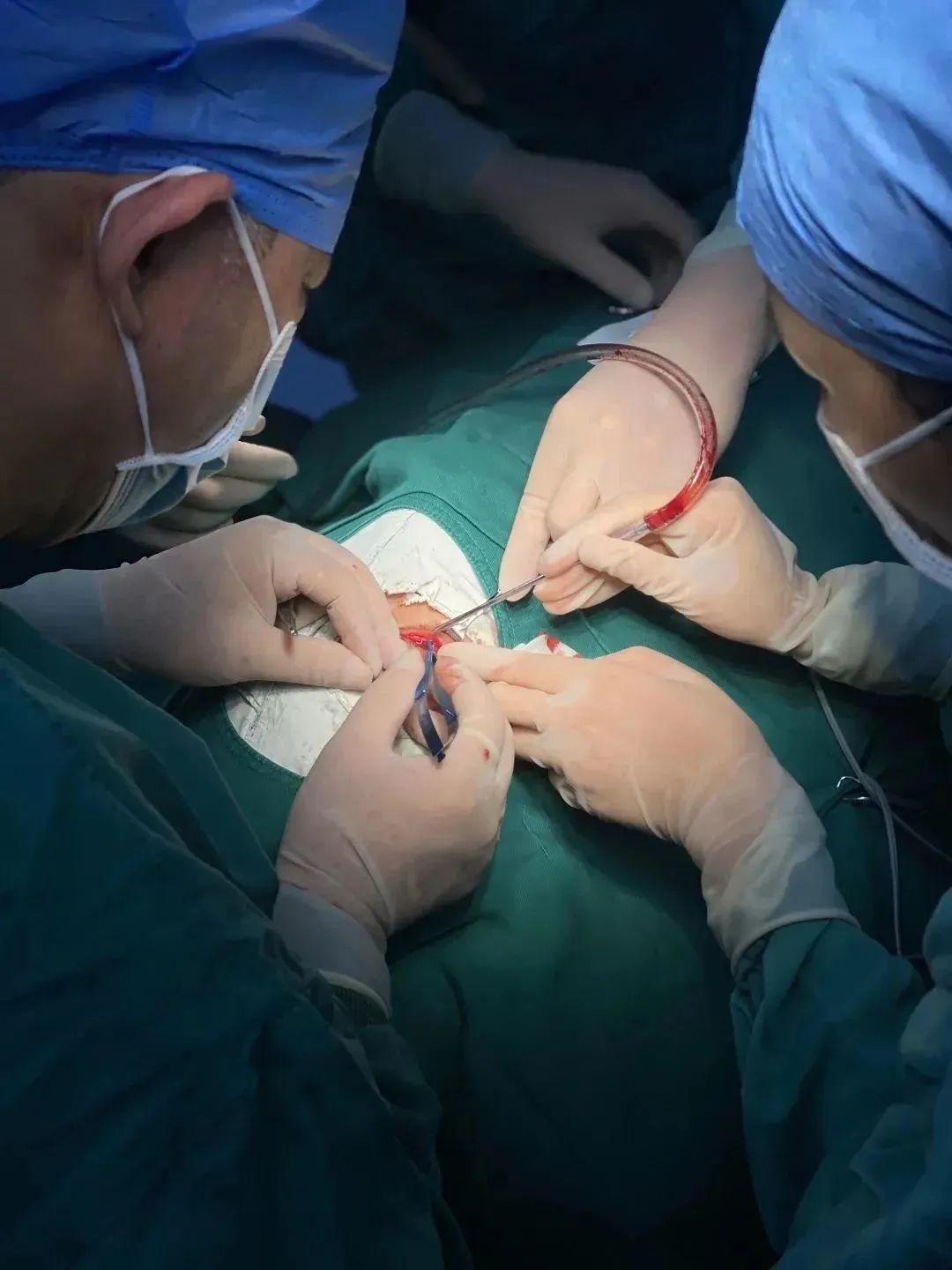 柳州市红十字会医院眼五病区成功开展眼眶球后巨大海绵状血管瘤摘除手术！