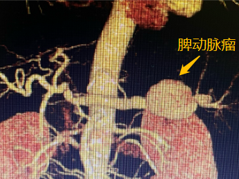 惊心动魄！动脉瘤破裂，医院响起 999，他们一个个化身短跑冠军冲进……