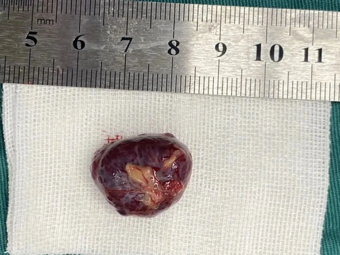 柳州市红十字会医院眼五病区成功开展眼眶球后巨大海绵状血管瘤摘除手术！