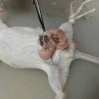 输卵管结扎手术