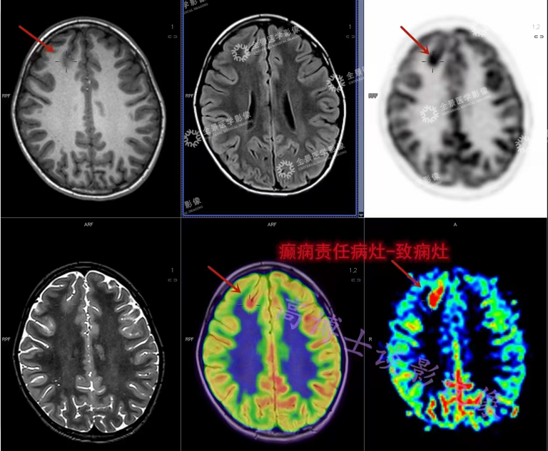 7 岁女孩突发癫痫，是如何检查捕捉到发作期变化的？