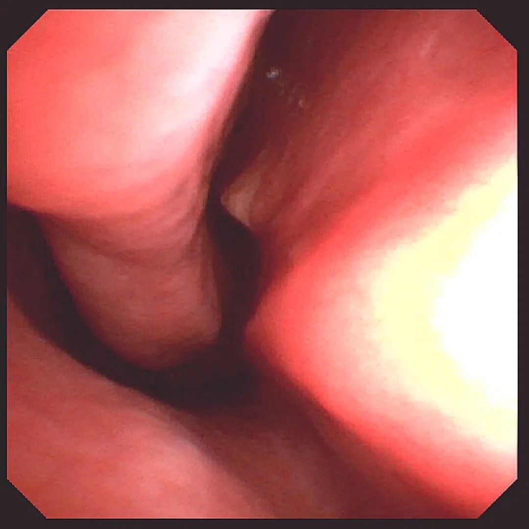 80 岁老人连续流鼻血，鼻内镜发现鼻中隔偏曲