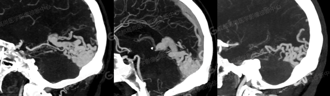 高尚病例：头颅 CTA 诊断脑动静脉畸形 1 例