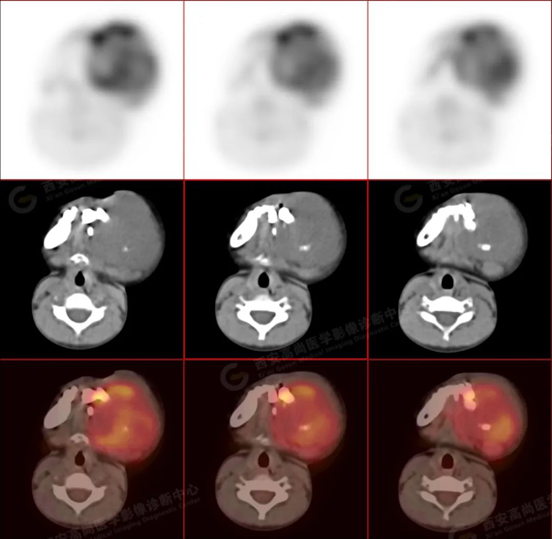 高尚病例:PET/CT 病例-儿童颌面部横纹肌肉瘤 1 例