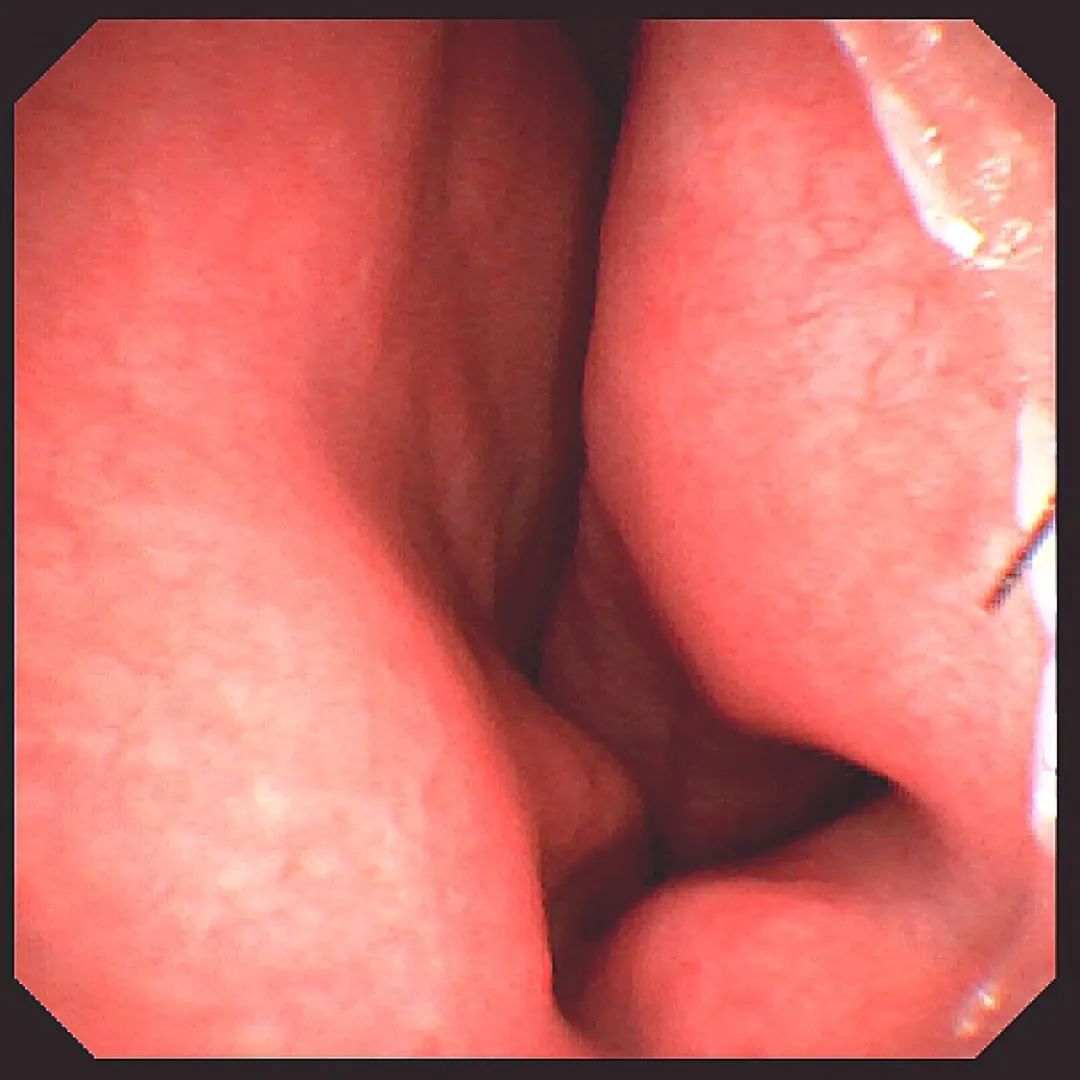 80 岁老人连续流鼻血，鼻内镜发现鼻中隔偏曲